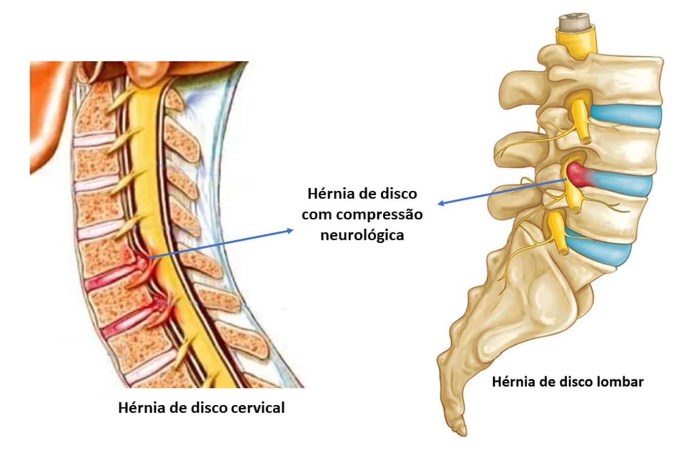 tratamento-da-hernia-de-disco.jpg